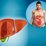 6 early symptoms signs of fatty liver
